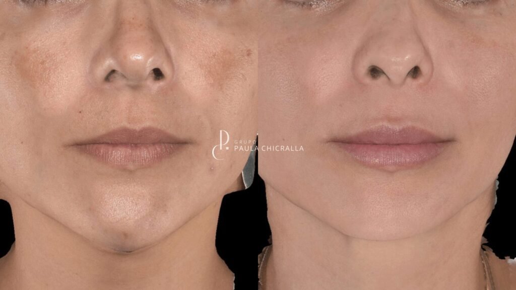 Melasma