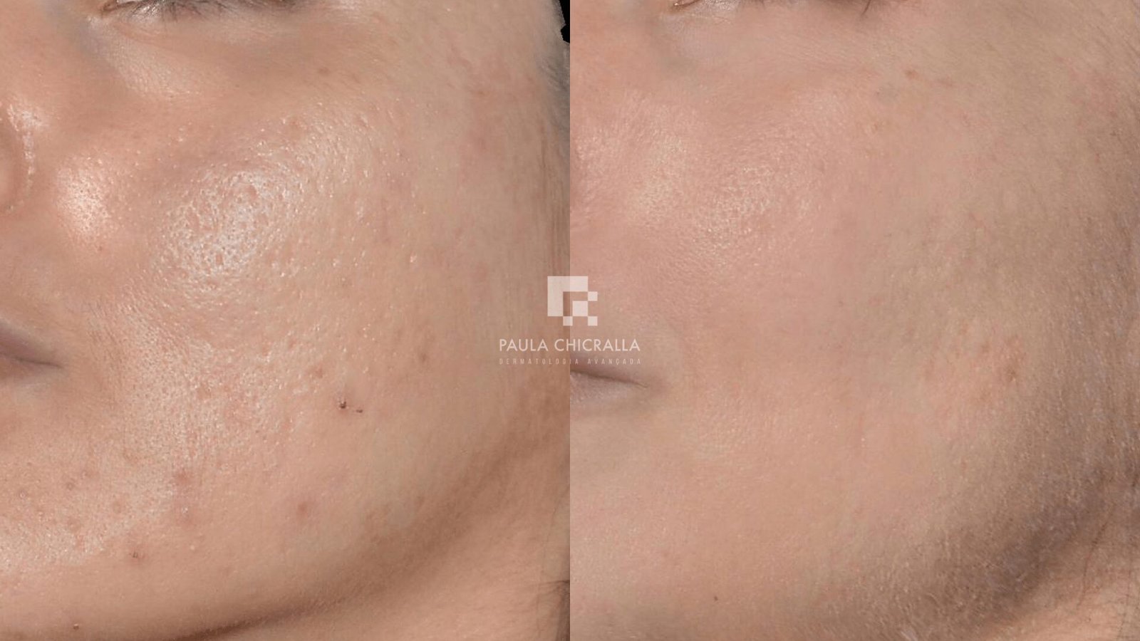 Tratamentos para Cicatrizes de Acne: Um Guia Completo de Tratamentos Eficientes | Grupo Paula Chicralla Frame 45403 min