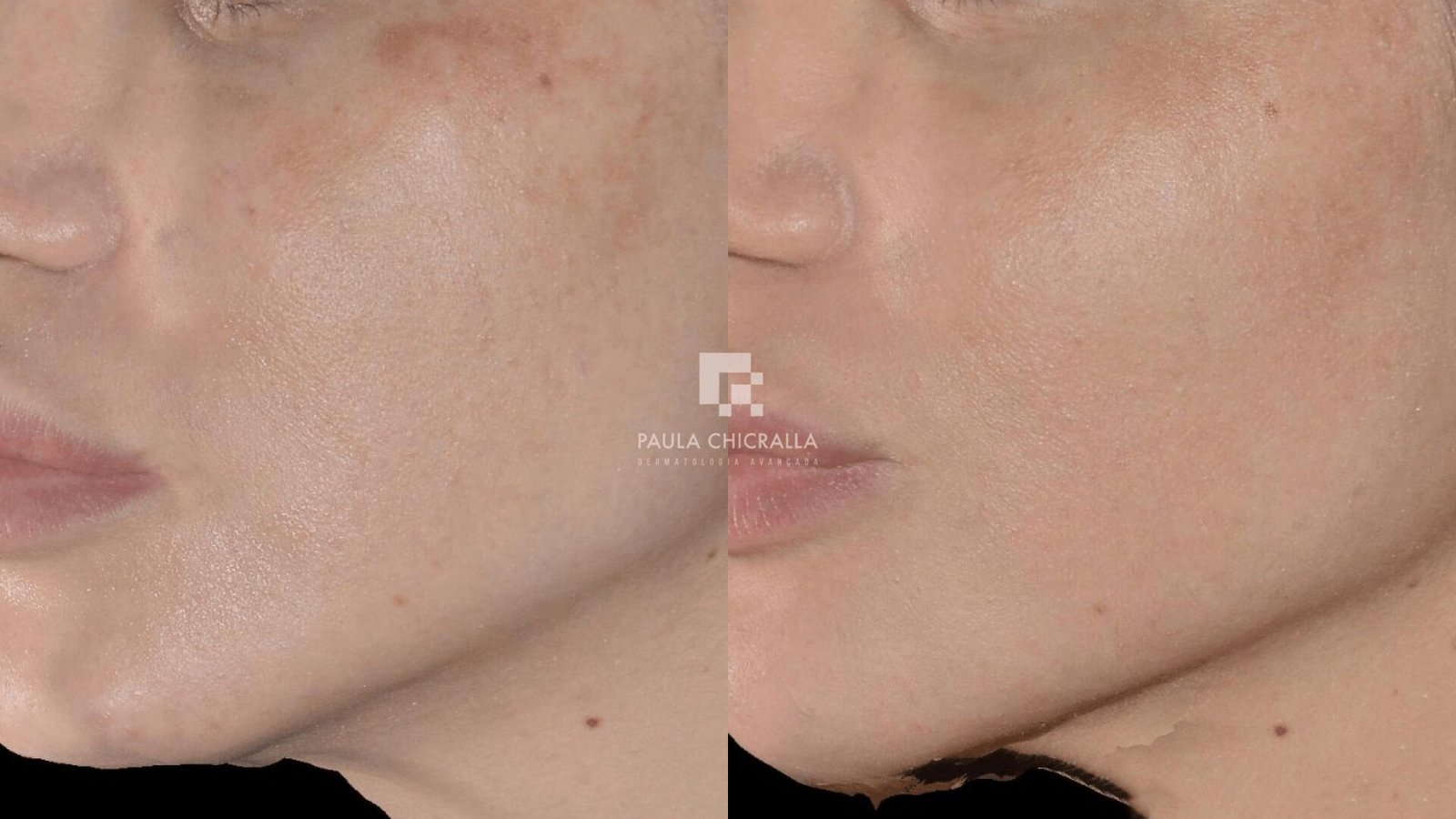 Tratamento para Melasma à Laser: Novidades na Dermatologia Estética | Grupo Paula Chicralla Frame 45404 min