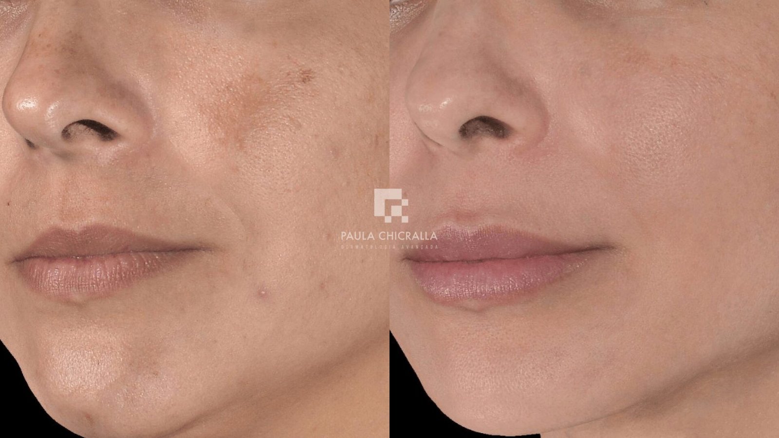 Tratamento para Melasma à Laser: Novidades na Dermatologia Estética | Grupo Paula Chicralla Frame 45405 2 min