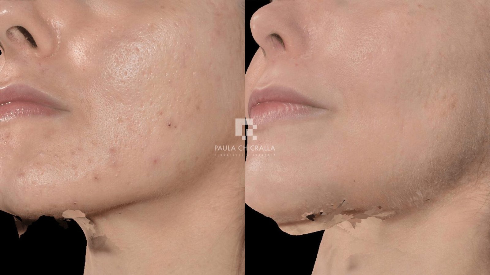 Tratamentos para Cicatrizes de Acne: Um Guia Completo de Tratamentos Eficientes | Grupo Paula Chicralla Frame 45444 min 2